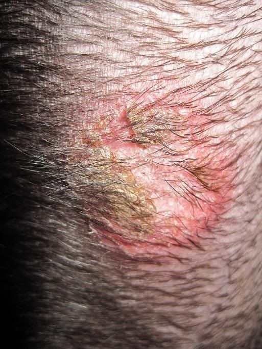 What Does Mrsa Look Like In Dogs